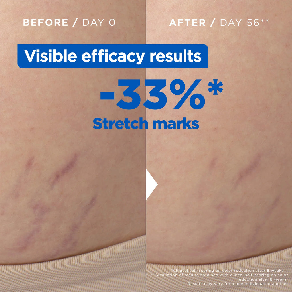 Mixa Anti Stretch Mark Oil For Skin with Stretch Marks With Omega 6 & 9