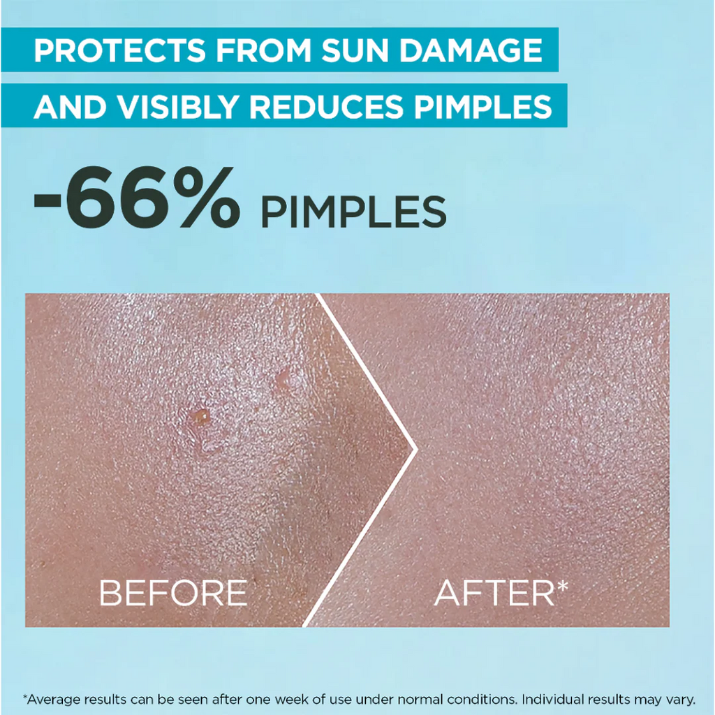 Garnier Super UV Anti-Acne SPF50+ Sunscreen – 12H Oil Control