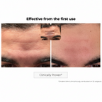 Kosmopellis Microneedling Anti-Aging Patch