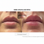 Kosmopellis Microneedling Lip Patch