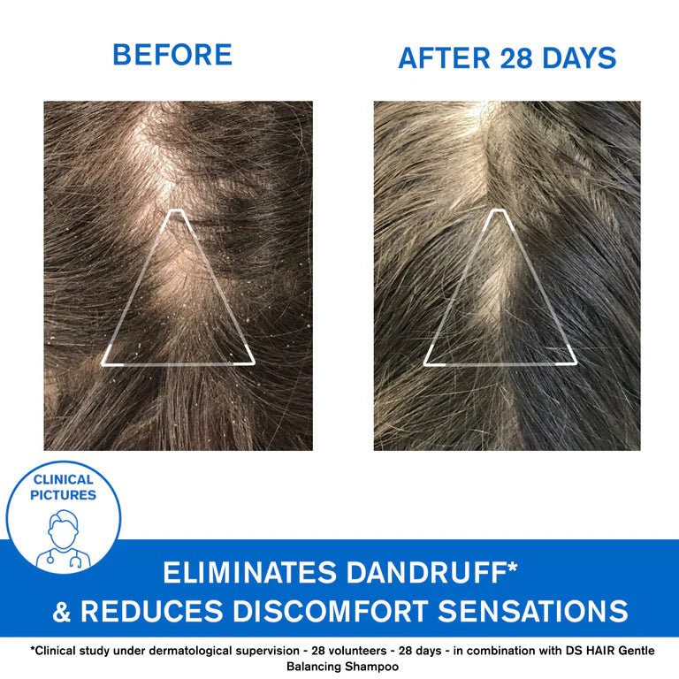 Uriage D.S. Hair Anti-Dandruff Treatment Shampoo - Moderate Dandruff & Irritated Scalp