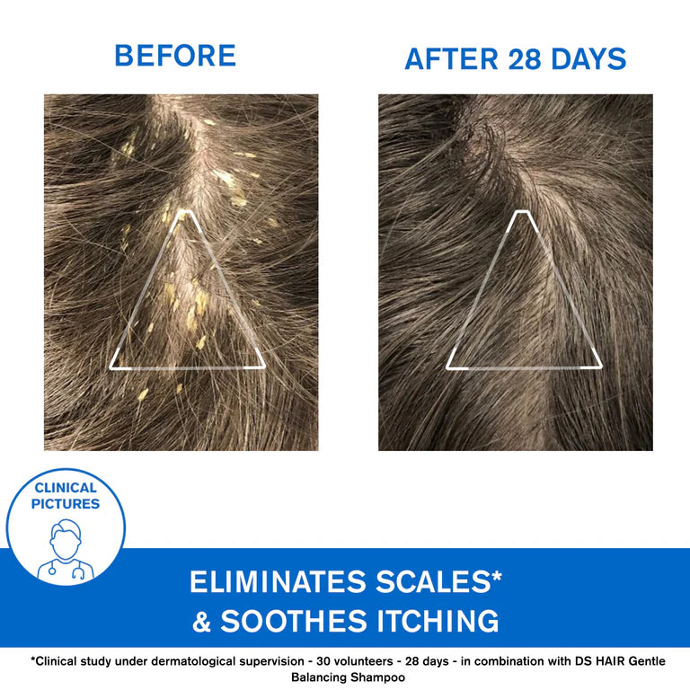 Uriage D.S. Hair Kerato-Reducing Treatment Shampoo - Severe Dandruff & Scaly Conditions