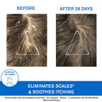 Uriage D.S. Hair Kerato-Reducing Treatment Shampoo - Severe Dandruff & Scaly Conditions