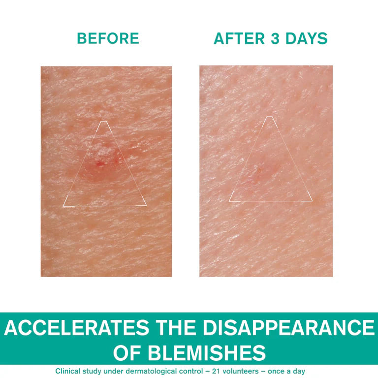 Uriage Hyseac SOS Paste - Local Skin-Care - Oily Skin with Blemishes
