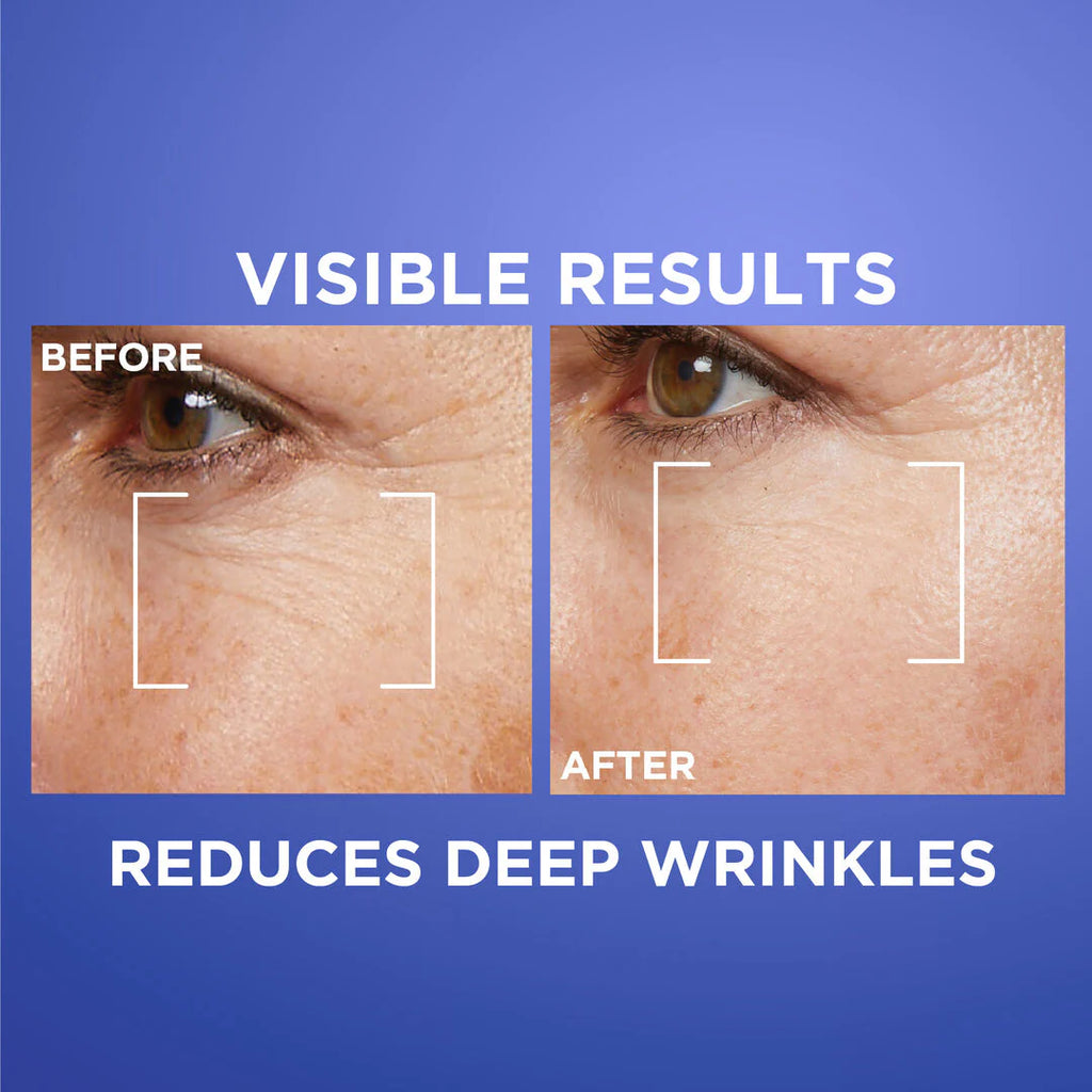 L’Oréal Paris Revitalift Laser Retinol Deep Wrinkle Night Serum, With Vitamin A, Targets all Wrinkles, 30ml