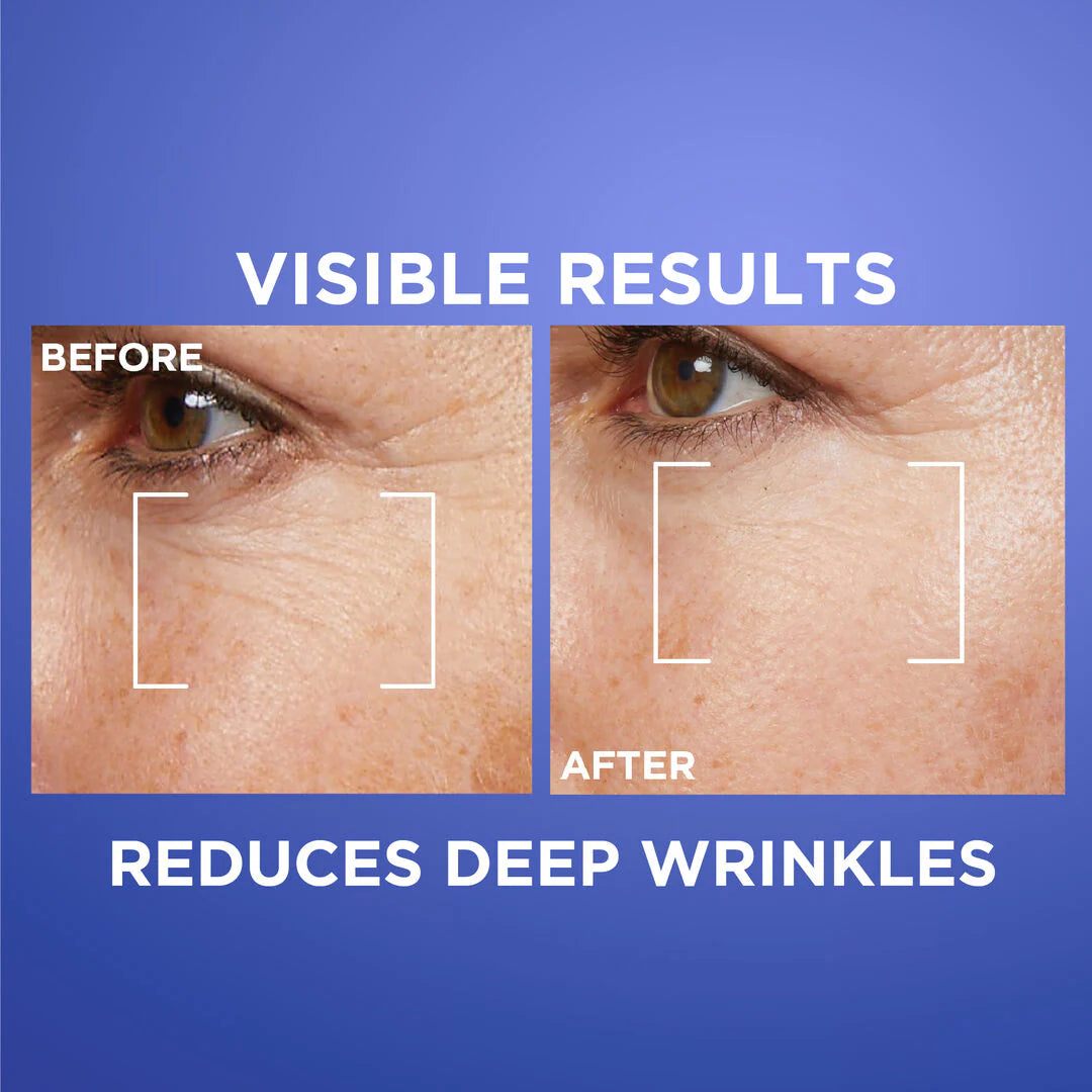 L’Oréal Paris Revitalift Laser Retinol Deep Wrinkle Night Serum, With Vitamin A, Targets all Wrinkles, 30ml